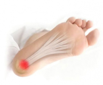 Fascitis Plantar: Causas, Síntomas y Tratamientos