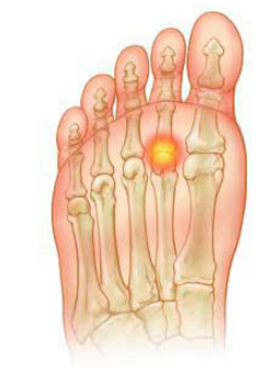Enfermedad de Freiberg: Una guía completa
