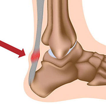 Tendinitis de Aquiles: Causas, Síntomas y Tratamientos Eficaces