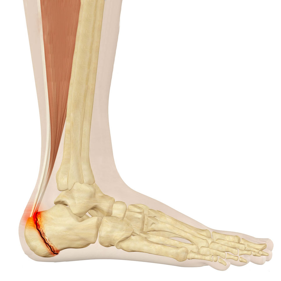 Enfermedad de Sever: Causas, Síntomas y Tratamientos
