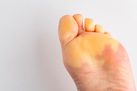 Síndrome de Raynaud: Diagnóstico y Tratamiento en Podología