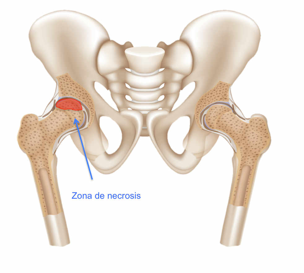 Necrosis Avascular: Una Guía Completa