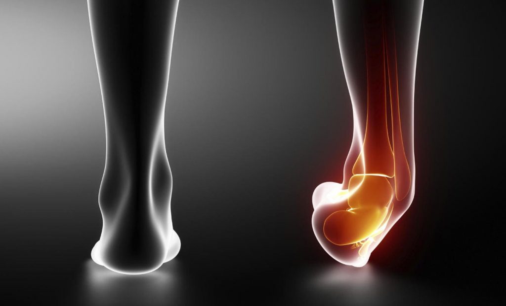 Displasia Fibrosa: Una Visión Integral y Su Tratamiento Podológico