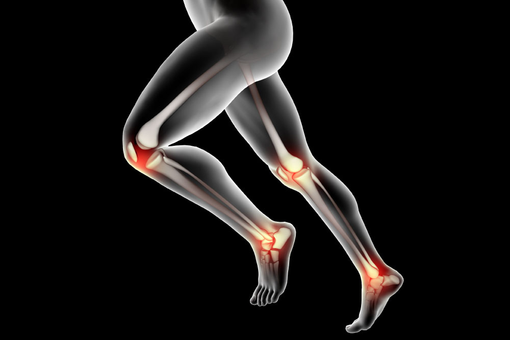 Osteoartritis: Comprensión, Síntomas y Tratamientos en Podología