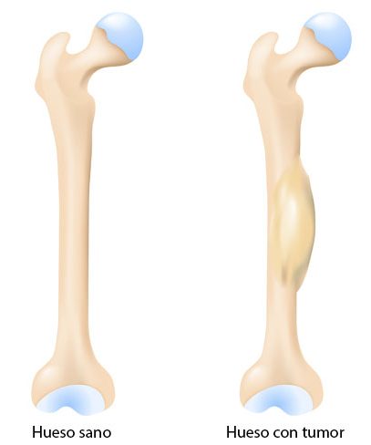 Sarcoma de Ewing: Un Enfoque Integral desde la Podología